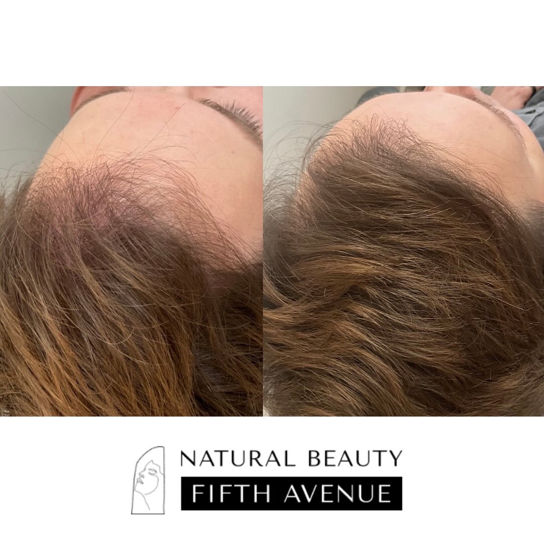 Before and after hair restoration showing increased density and fuller coverage on the scalp